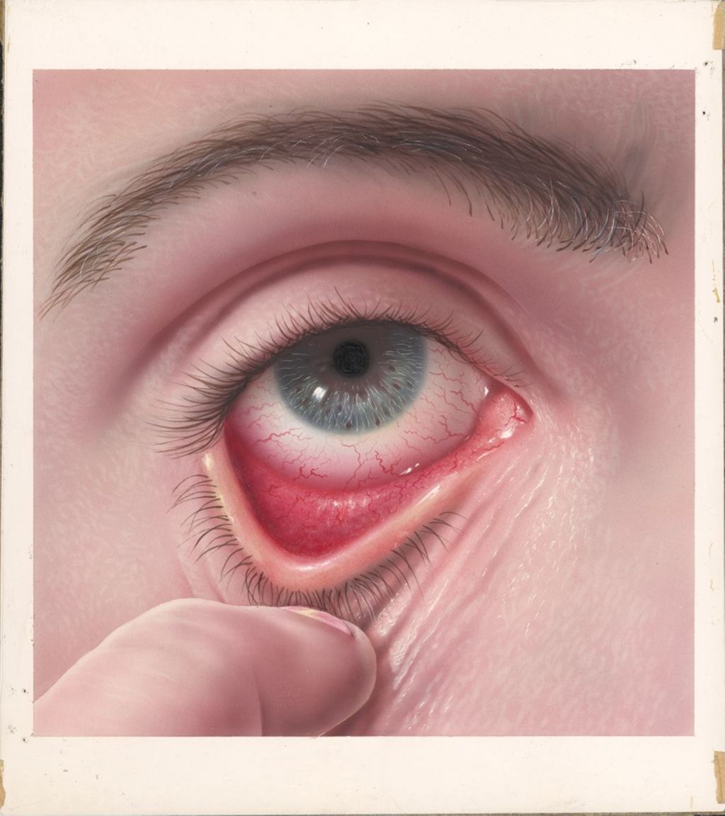 Miniature of Eye infected with allergic blepharoconjunctivitis