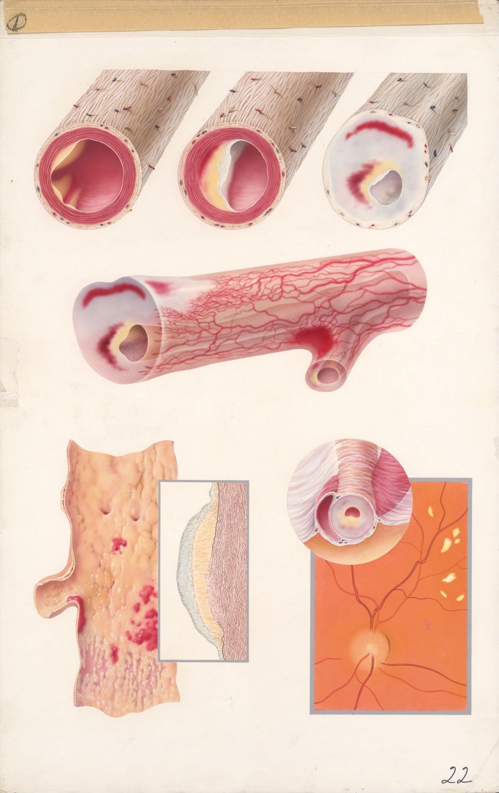 Miniature of Medical Profiles, Diuril, Abnormalities of blood vessels