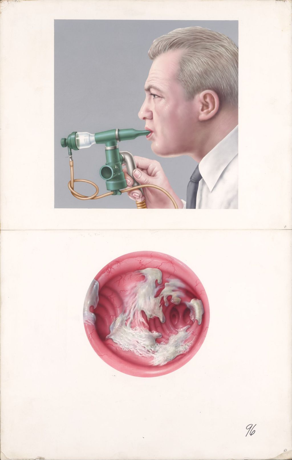 Miniature of Medical Profiles, Dornavac, The use of dornavac and nebulizer in chronic obstructive lung disease
