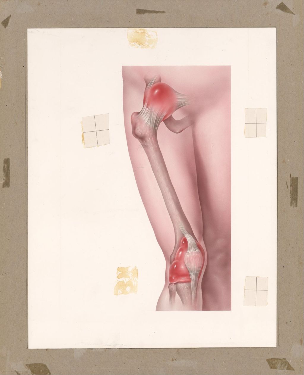 Miniature of Joint inflammation of hip and knee