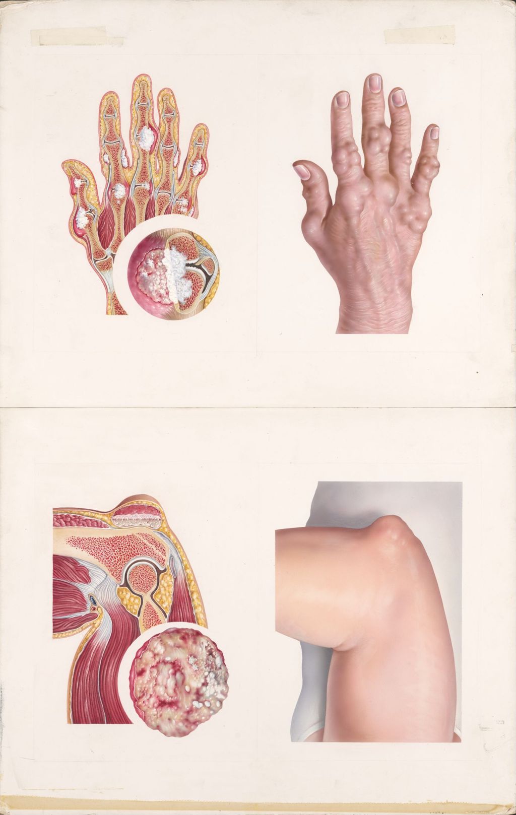 Medical profiles, Benemid, Colbenemid, Typical sites of gouty arthritis as seen externally and in Plate 1