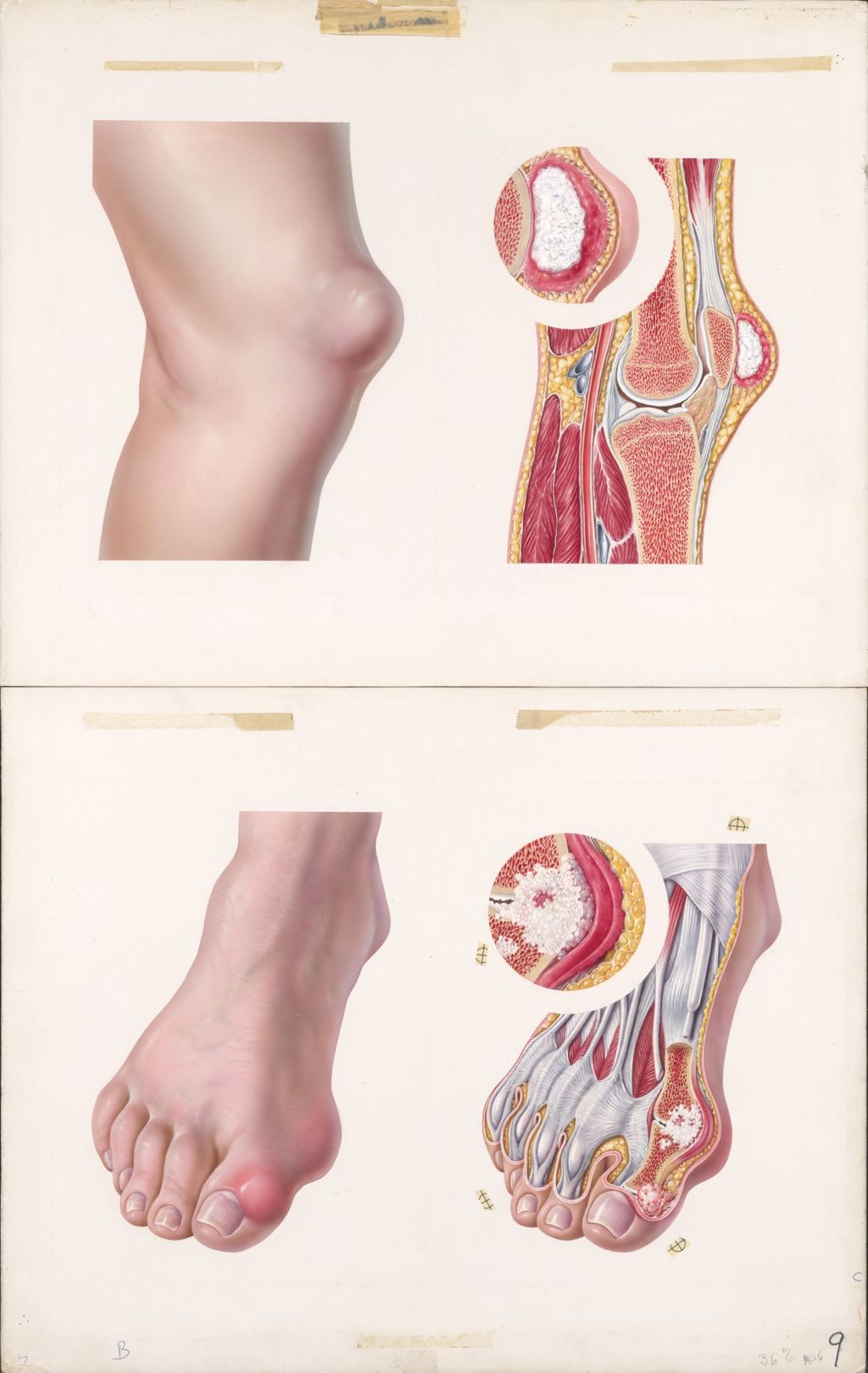 Miniature of Medical Profiles, Benemid, Colbenemid, Typical sites of gouty arthritis as seen externally and in section Plate 2
