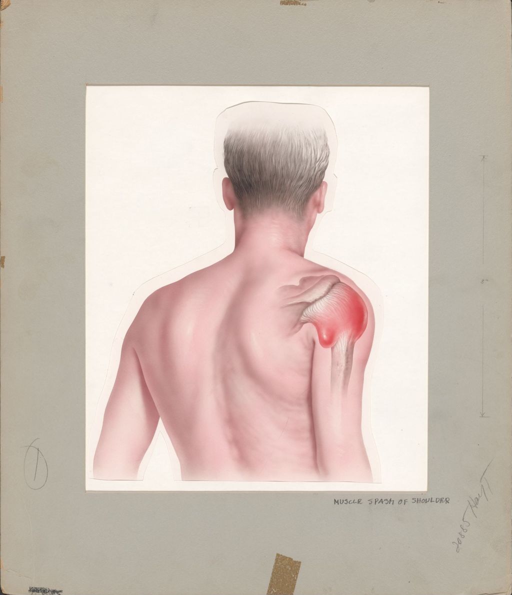 Miniature of Inflammation, shoulder joint capsule