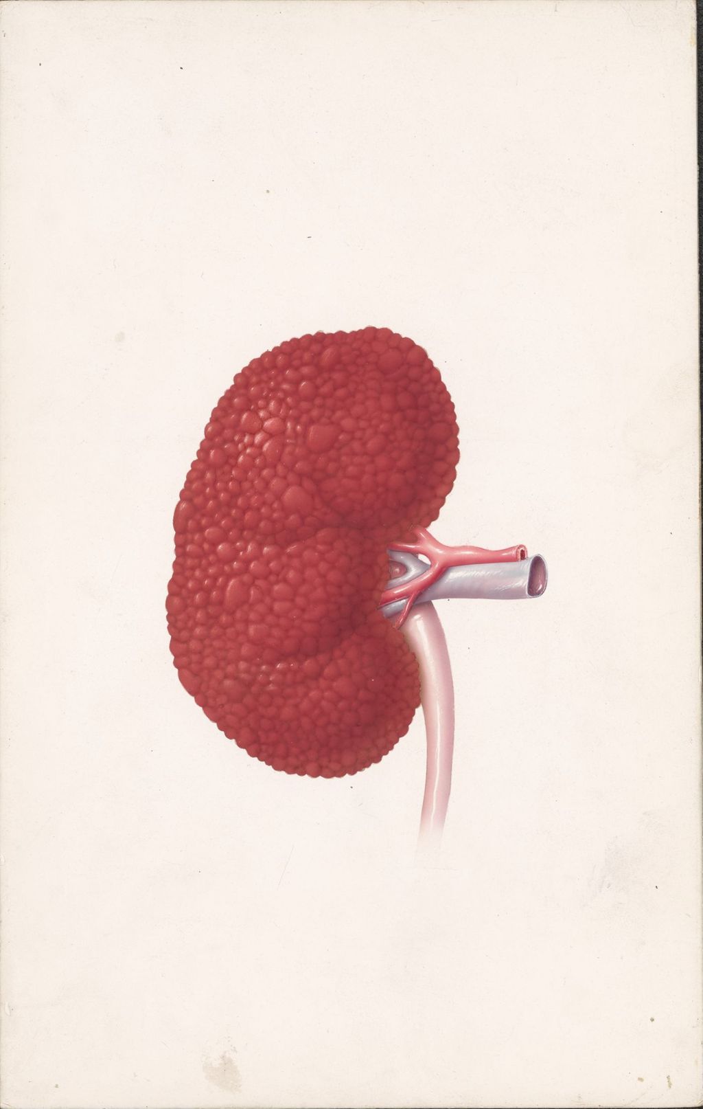 Miniature of Diuril, Journal ad, Nephrosclerosis, Edema of renal origin