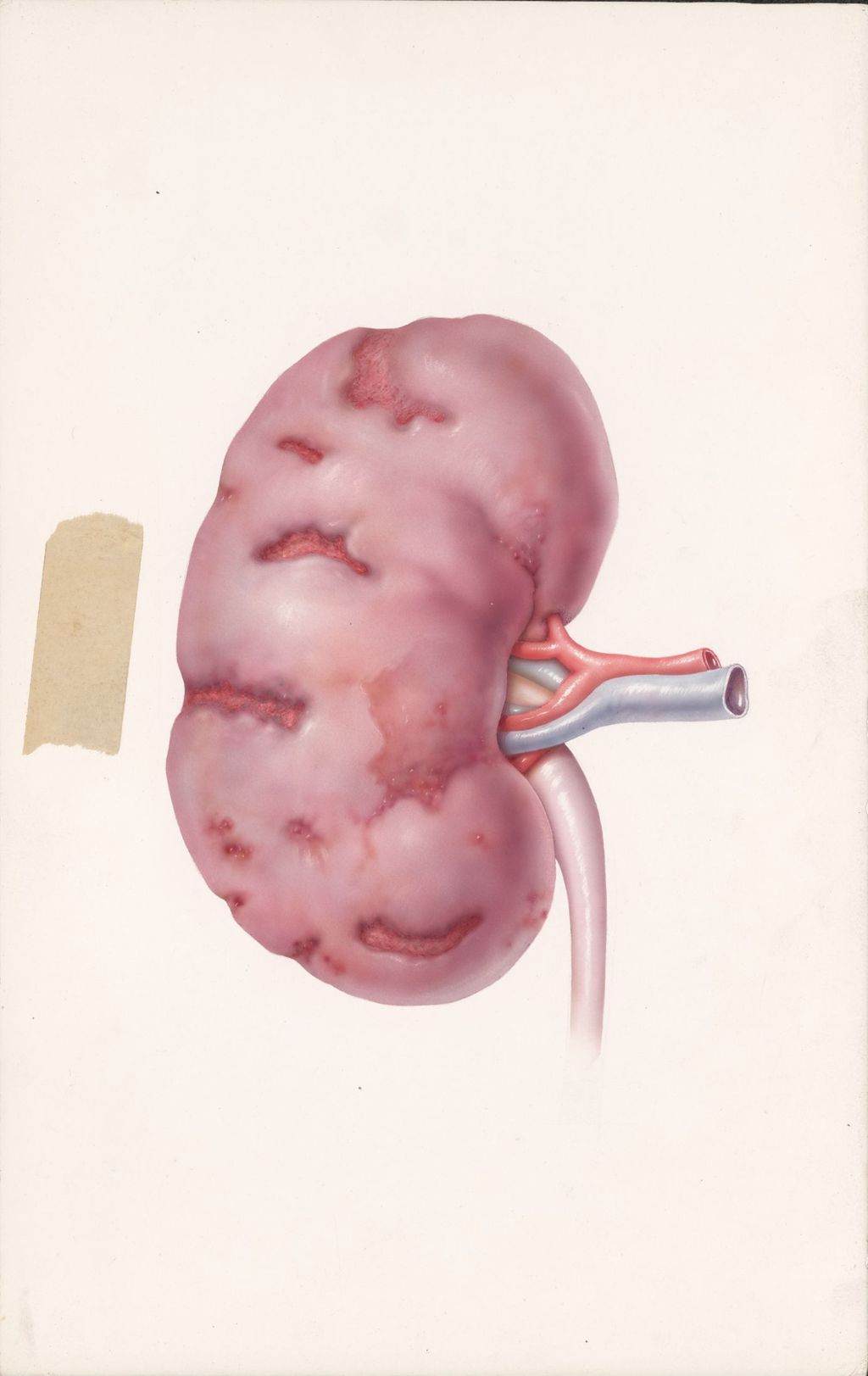 Miniature of Diuril journal ad, Chronic pyelonephritis, Edema of renal origin