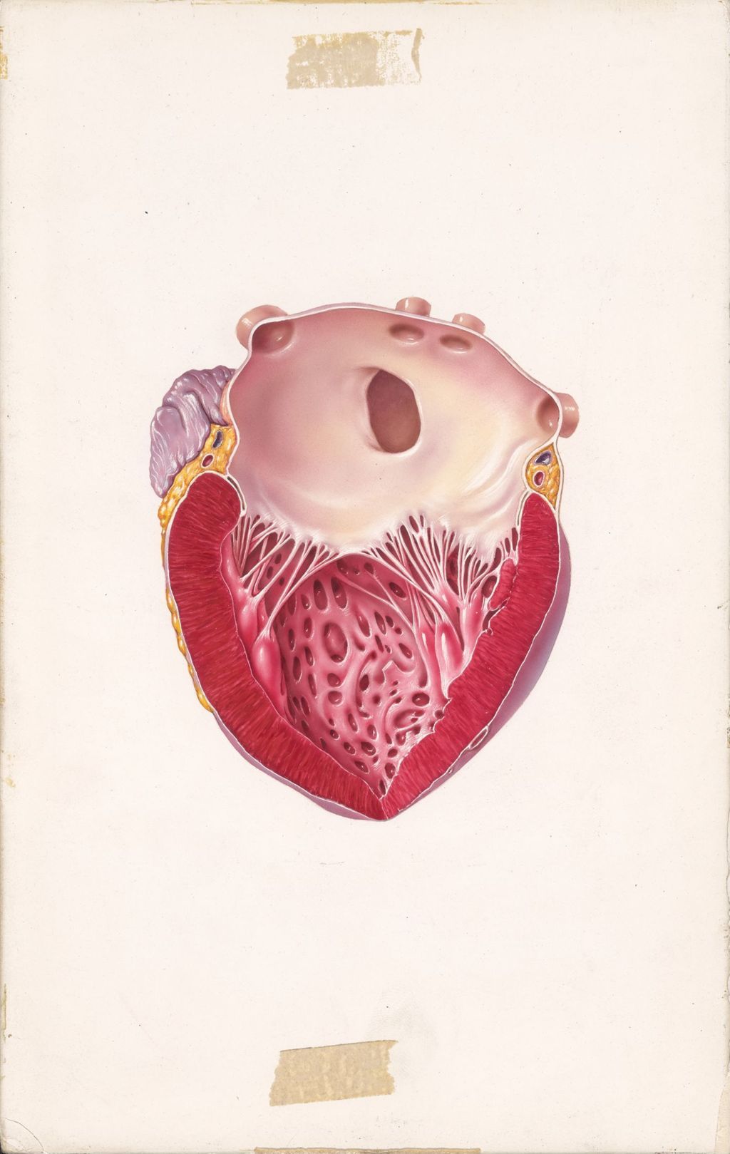 Miniature of Edema of cardiac origin, Diuril-Hydrodiuril, Atrial-septal defect