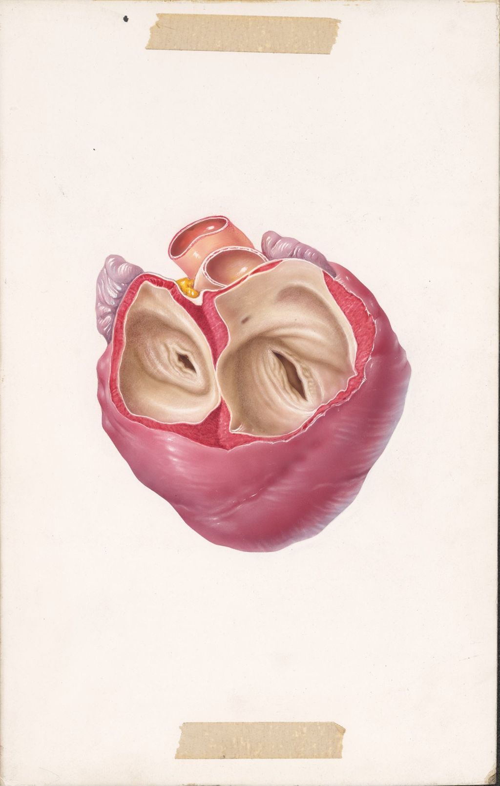 Edema of cardiac origin, Diuril-Hydrodiuril, Rheumatic heart disease