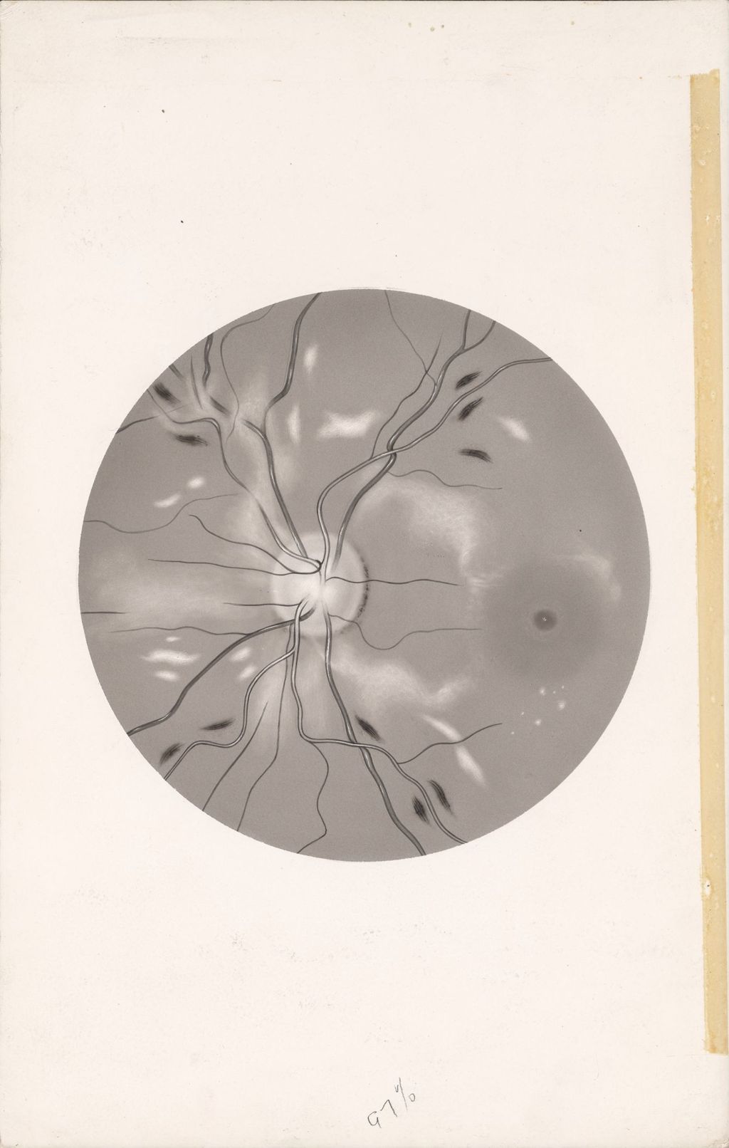 Miniature of Fundus in hypertensive retinopathy showing arteriovenous nicking, edema of retina, cotton wool spots, and retinal hemorrhages
