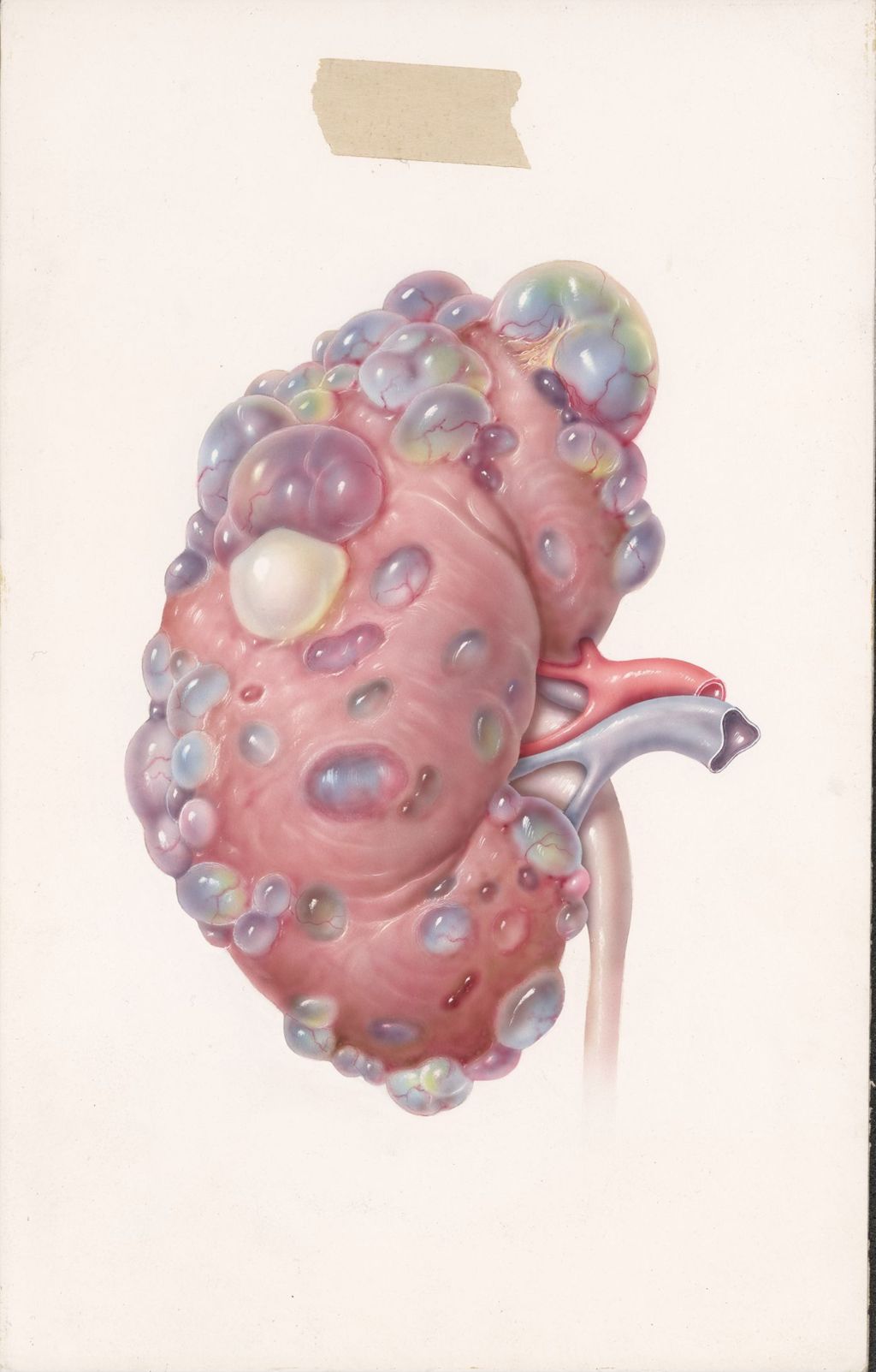 Miniature of Hypertension and the kidney, Diuril, Polycystic kidney disease