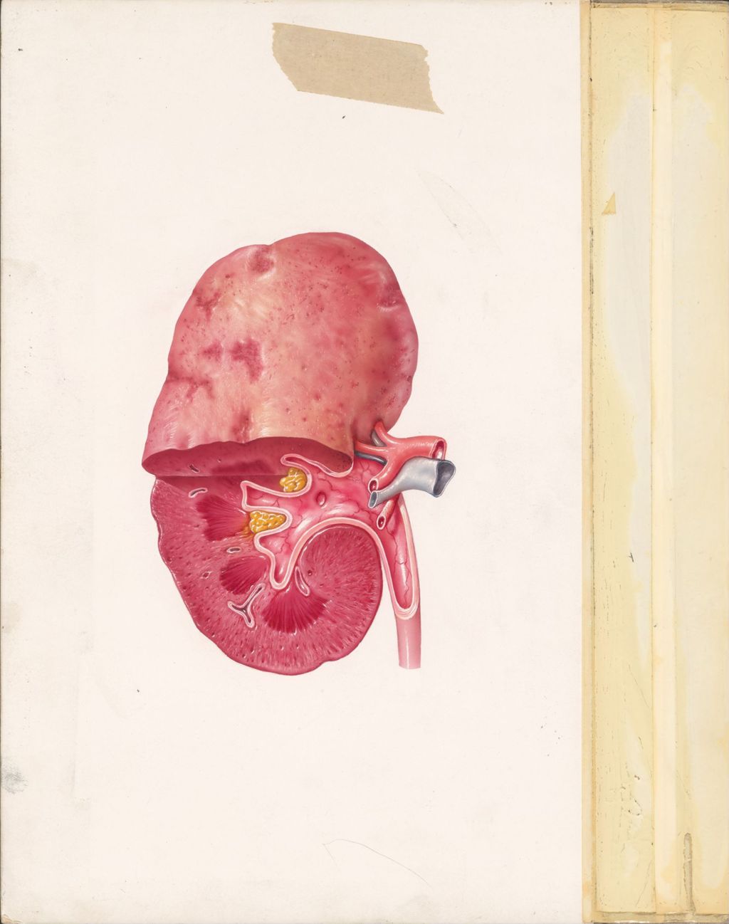 Hypertension and the kidney, Diuril, Gross view of pyelonephritis