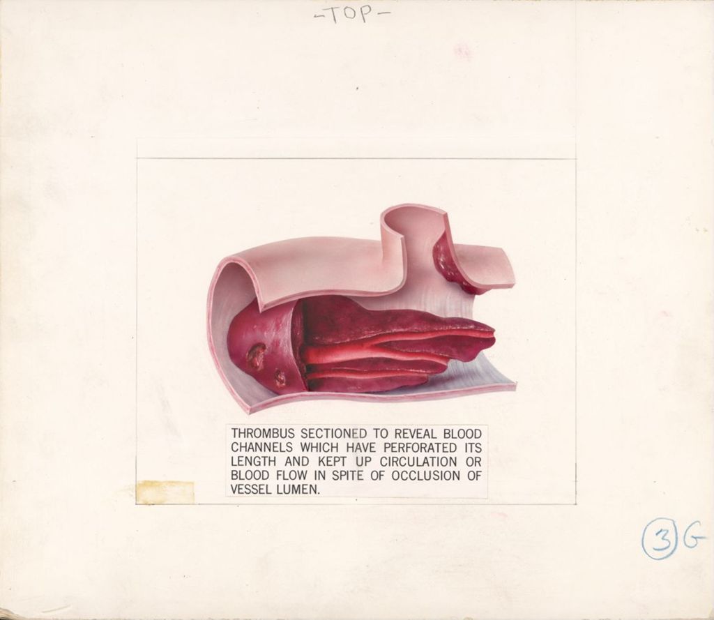 Miniature of Thrombolysin training film, Well organized thrombus sectioned to reveal channels of blood flow