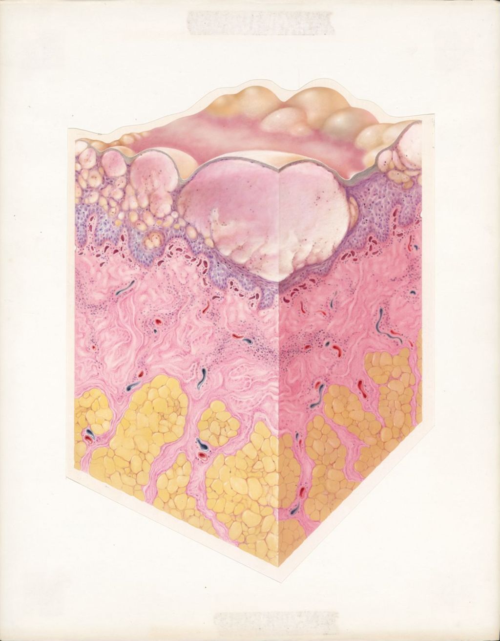 Miniature of Acute contact dermatitis, Tangential-transverse sections
