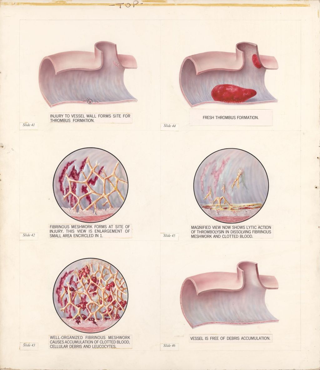 Miniature of Thrombolysin training film, Six progressive steps in development of thrombus and its prevention through the lytic action of Thrombolysin