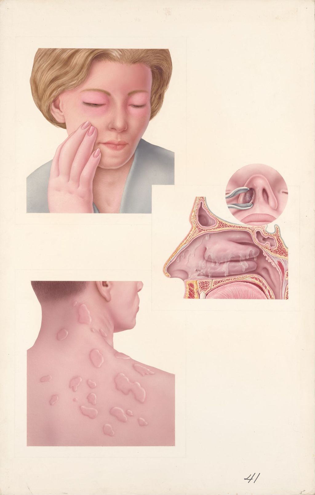 Miniature of Medical Profiles, Decadron, Dual phase, Several representative manifestations of allergic reactions