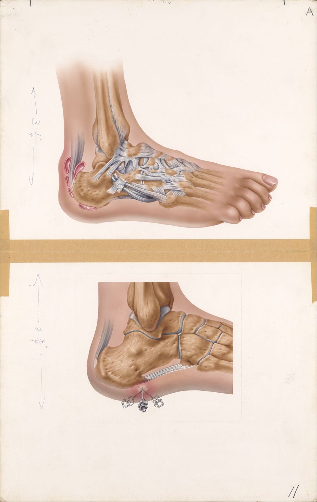 Medical Profiles, Hydeltra TBA Plate II, Bursae of the heel, Heel spur