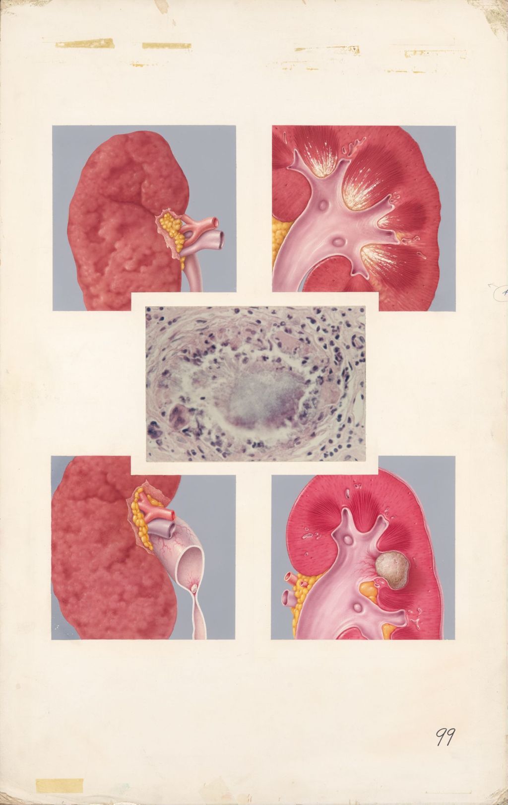 Medical Profiles, Benemid, Plate 1, The kidney in gout