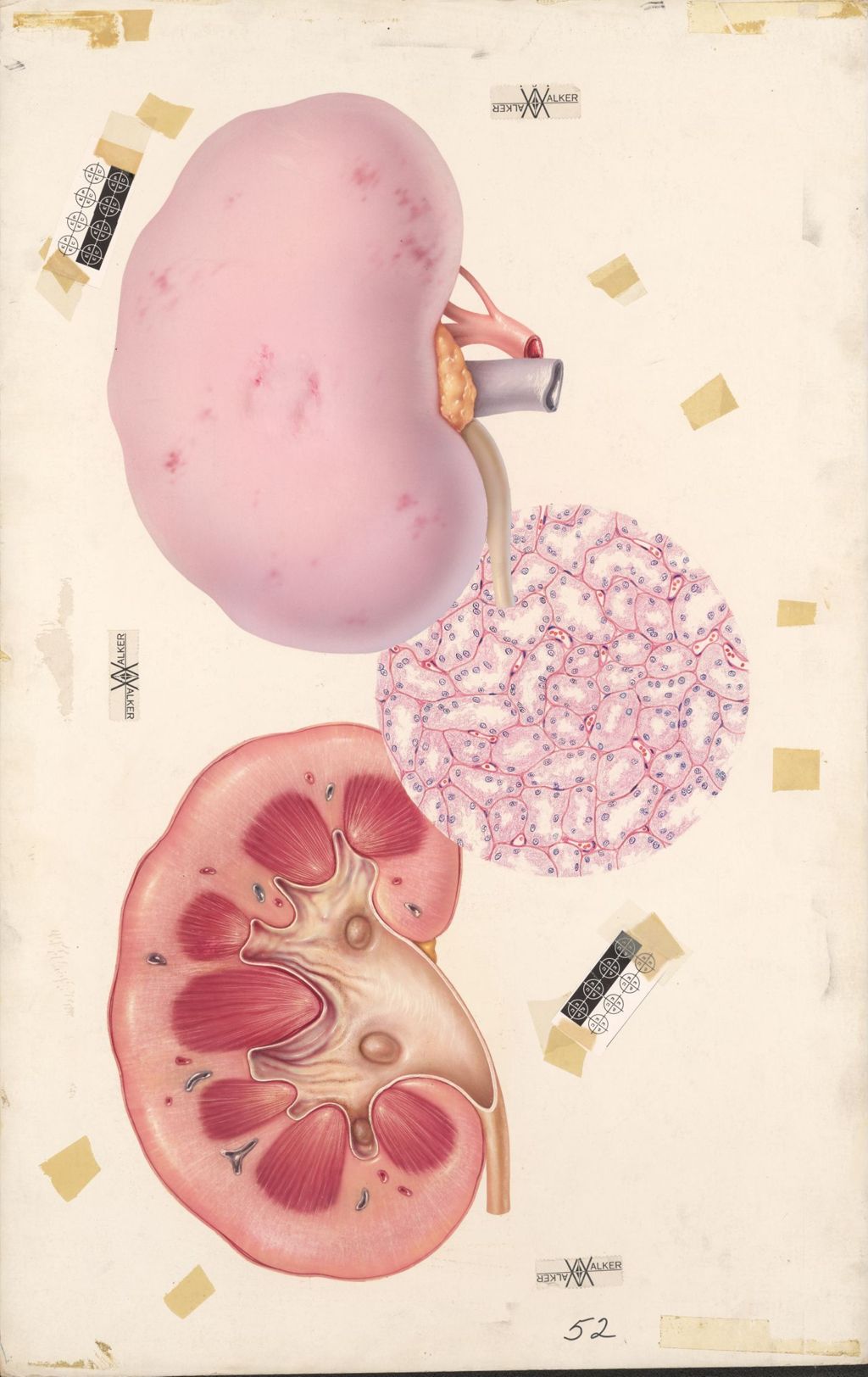 Miniature of Diuril and Hydrodiuril, Acute Nephrosis, The external view depicts the pale, swollen kidney