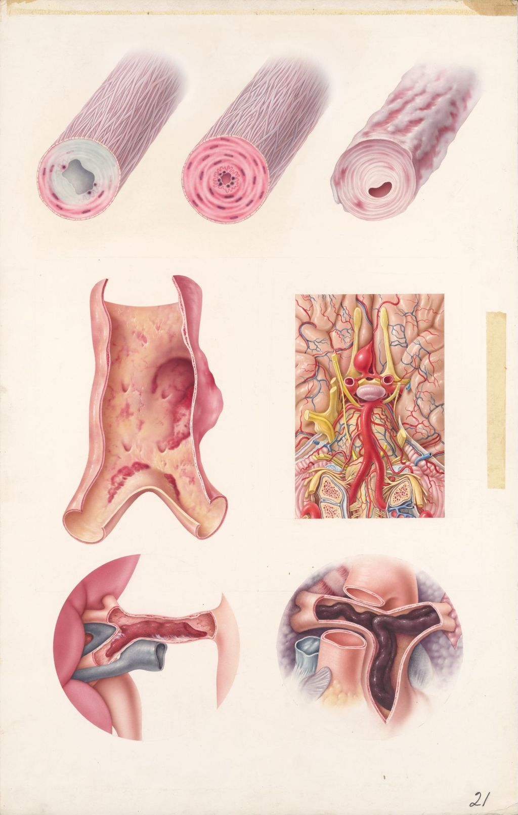 Medical Profiles, Diuril, Abnormailities of blood vessels, Plate 1