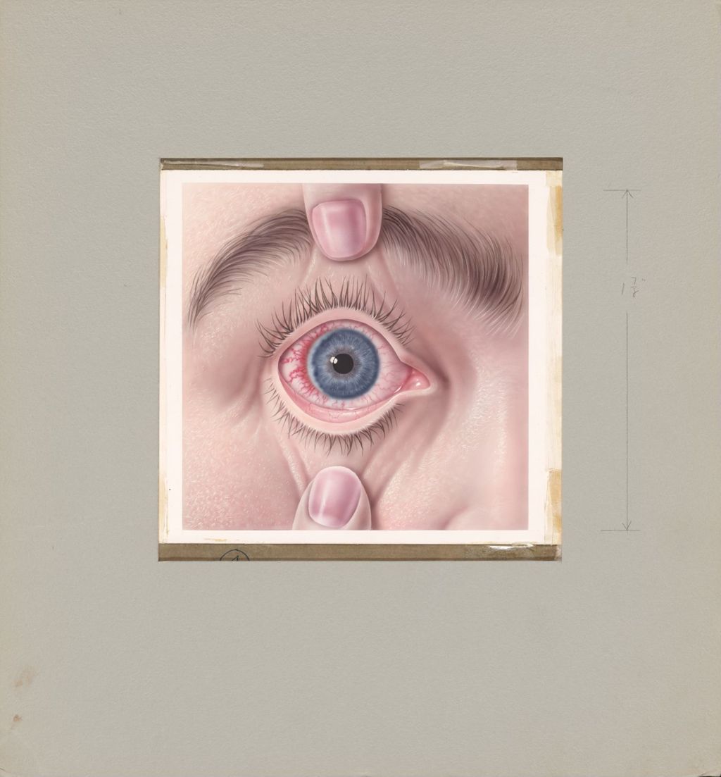 Miniature of Booklet on common eye disorders, Corneal ulcer on margin of limbs