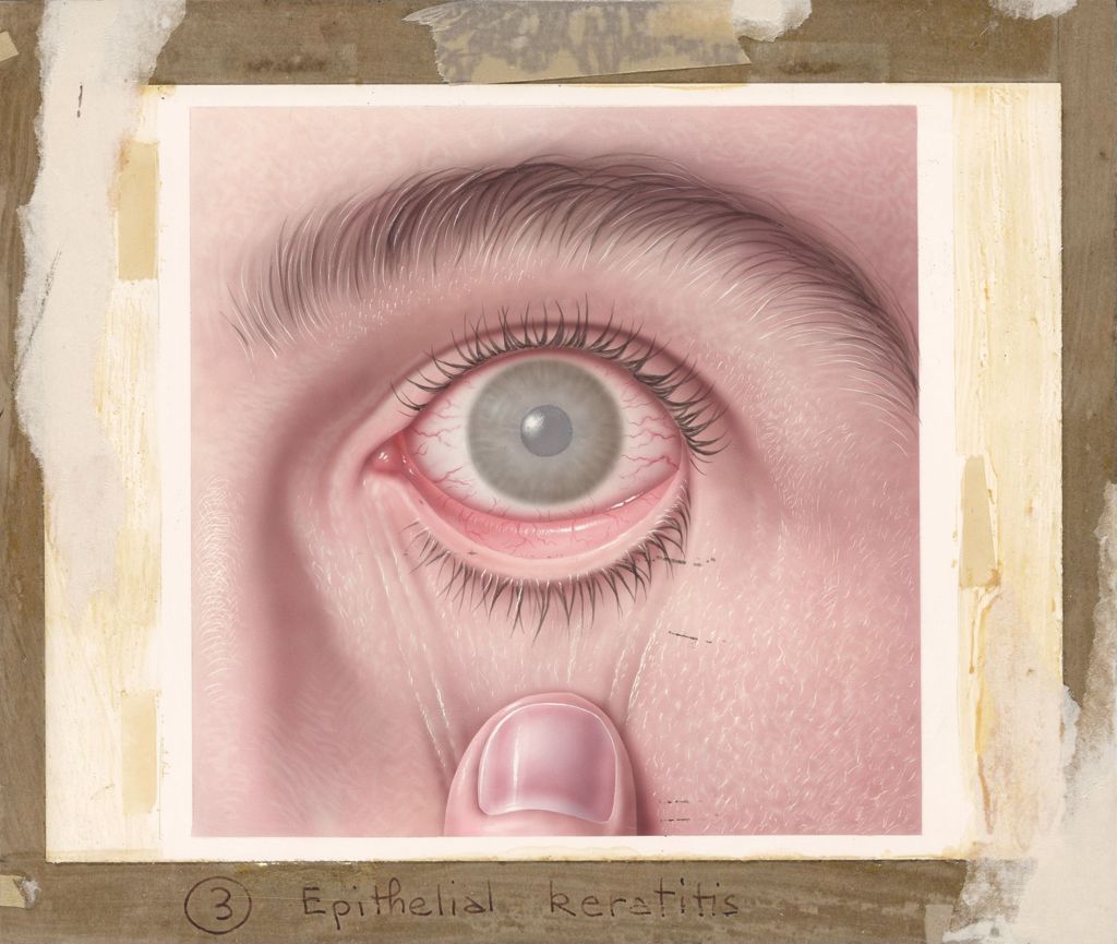 Miniature of Booklet on common eye disorders, Epithelial keratitis