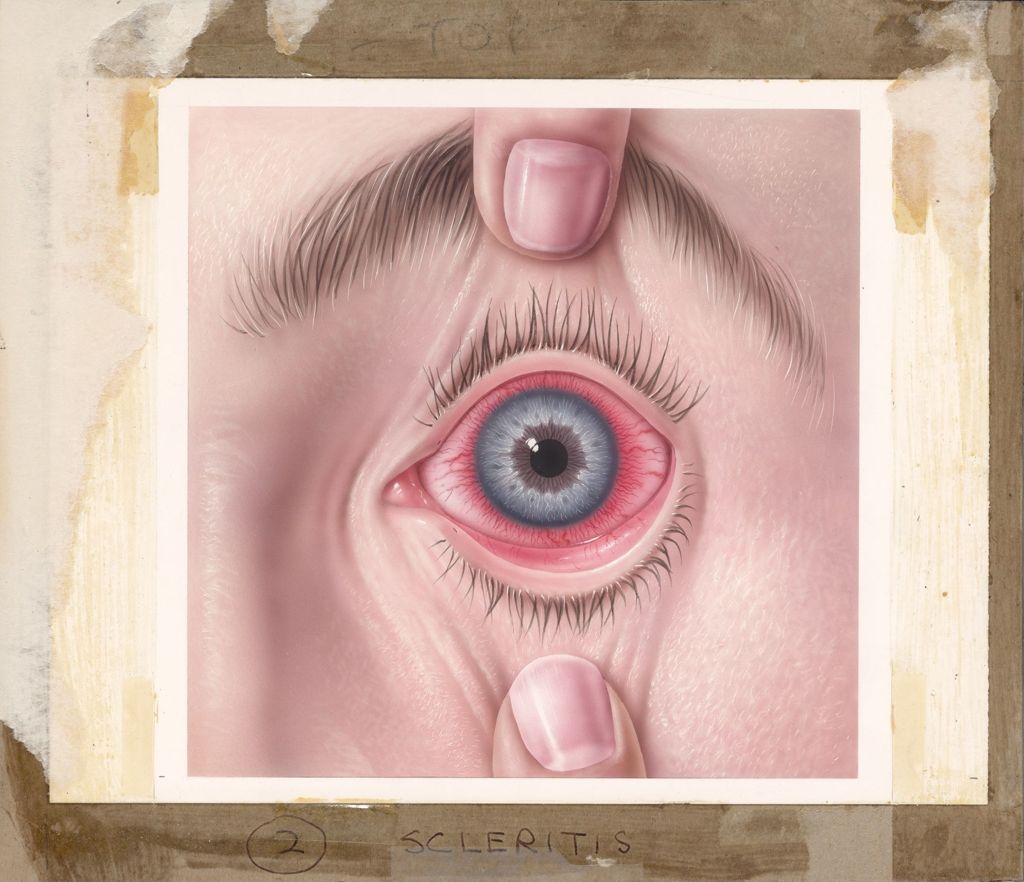 Miniature of Booklet on common eye disorders, Scleritis