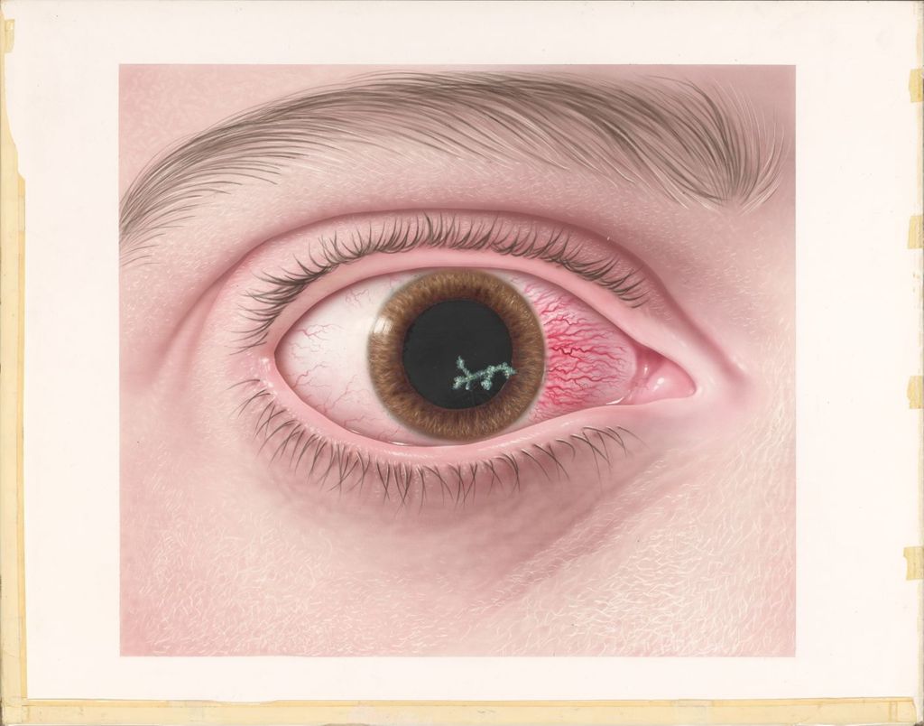 Miniature of Neodecadron Ophthalmic, Herpes Simplex