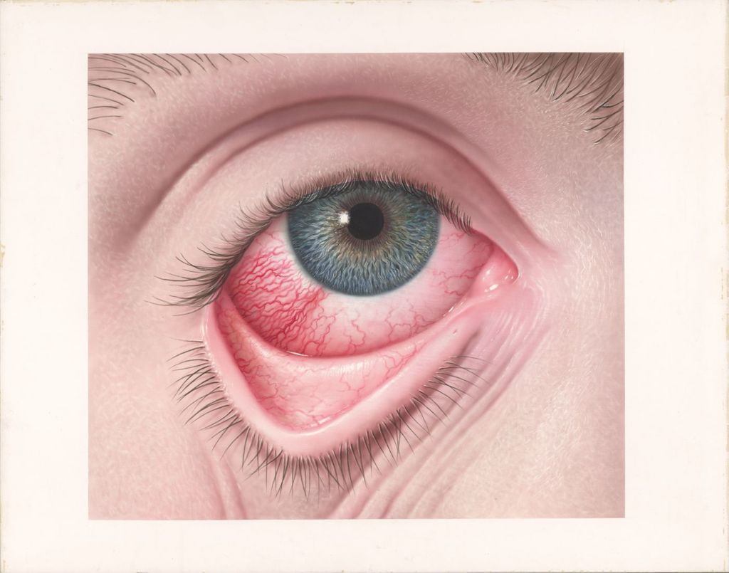 Miniature of Neodecadron opthalmic, Episcleritis, A keratitis which can be treated with steroids