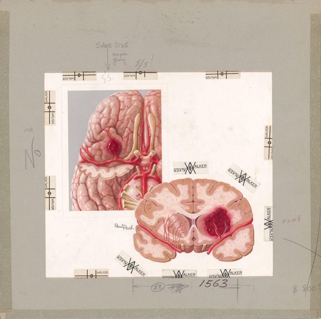 Miniature of Brain aneurysm