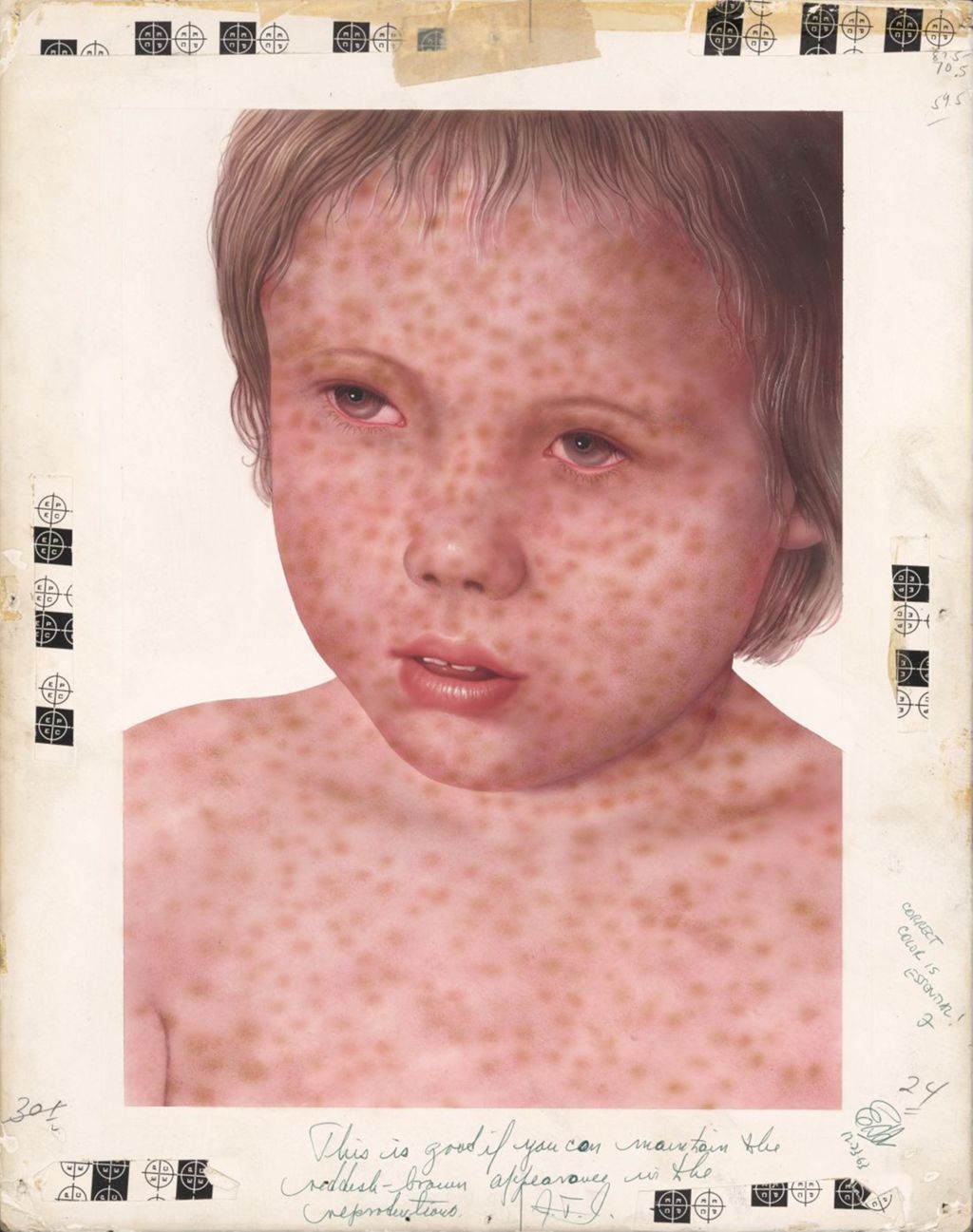 Rubeovax, Measles
