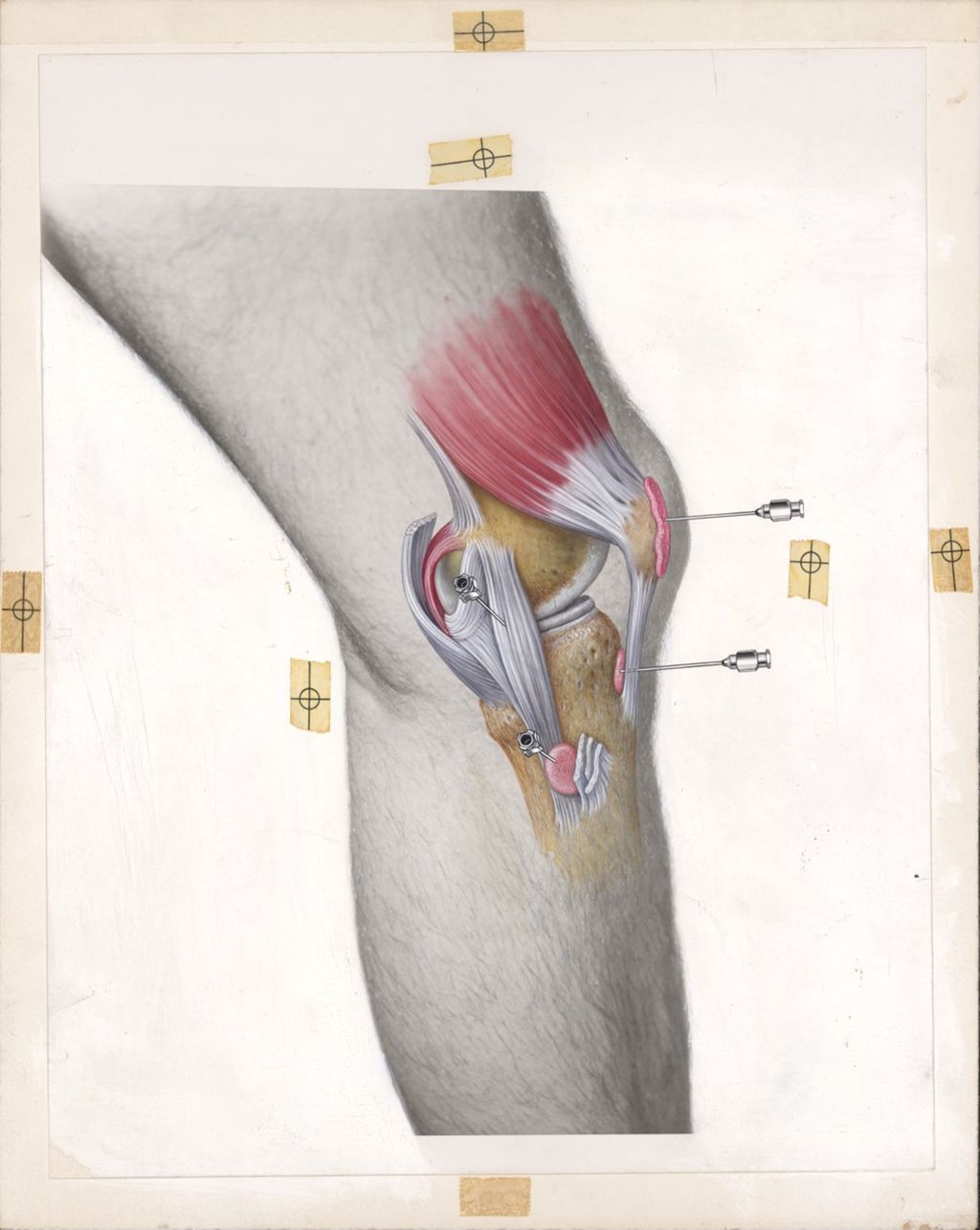 Miniature of Periarticular conditions of the knee