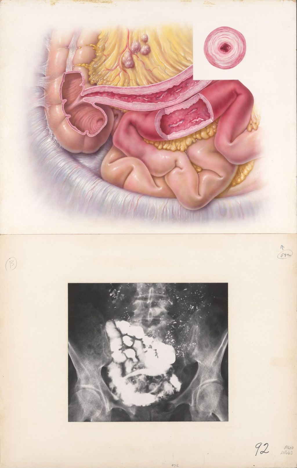 Miniature of Medical Profiles, Decadron, Noninfectious inflammatory diseases of the intestine, Plate 2, regional enteritis