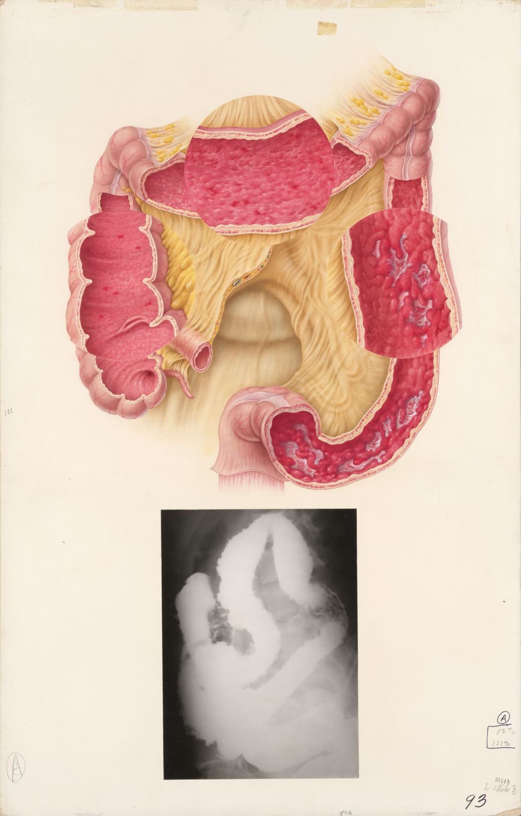 Medical profiles, Decadron, Noninfectious imflammatory diseases of the intestine, Plate 1, non-specific ulcerative colitis