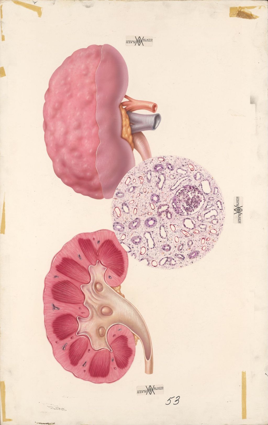 Miniature of Medical profiles, Diuril and Hydrodiuril, Chronic Glomerulonephritis
