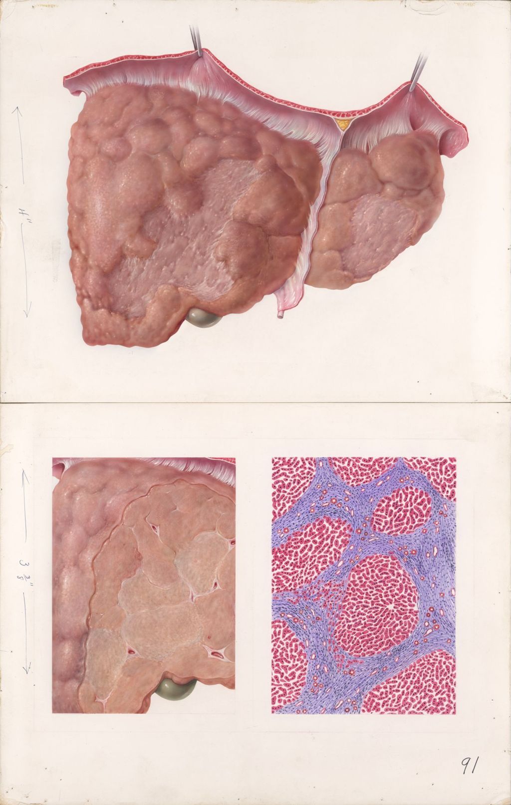 Miniature of Medical profiles, Post-Hepatitic cirrhosis (Diuril-Hydrodiuril), Plate 2