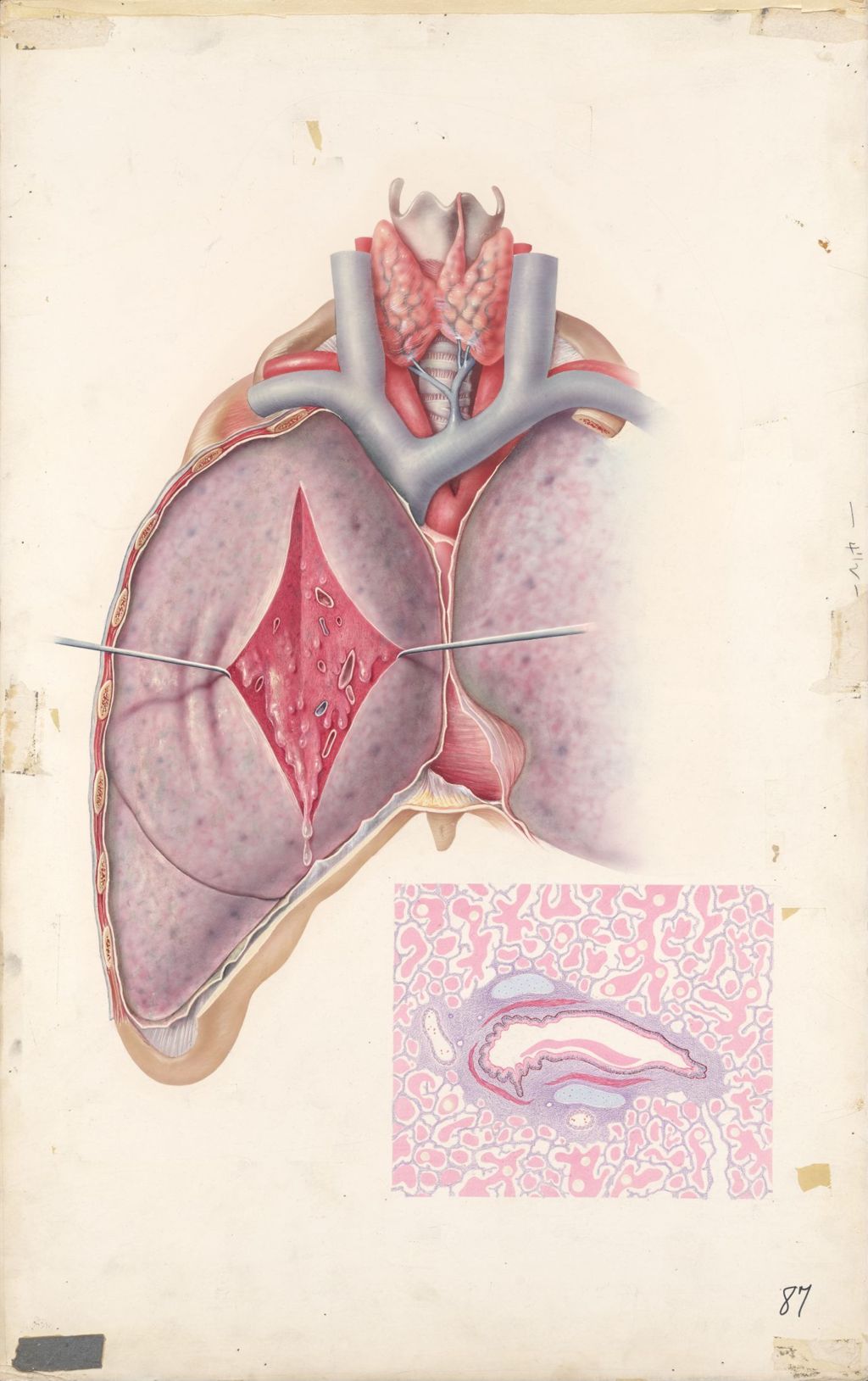 Miniature of Medical profiles, Diuril-Hydrodiuril, Gross view of the lung in pulmonary edema, Microscopic view of section of lung