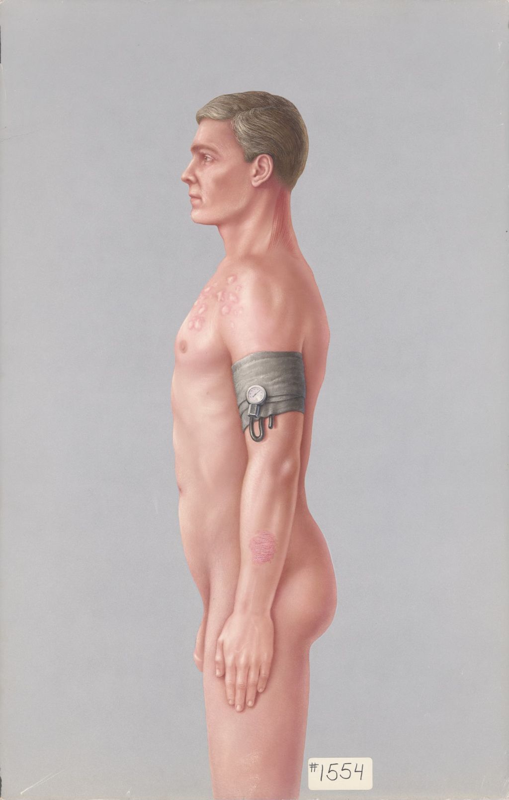 Miniature of Side profile of man with blood pressure cuff and skin lesions,