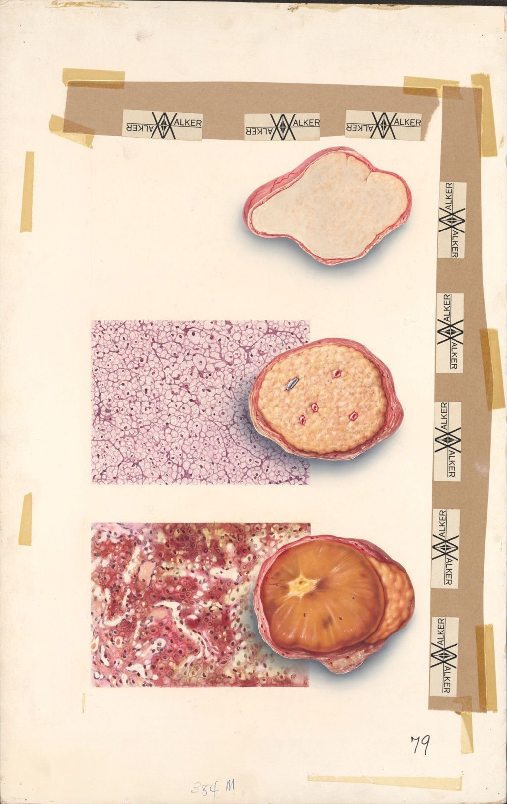 Miniature of Tumors of the Adrenal glands, Addison's Disease, Cushing's Disease, Pheochromocytoma