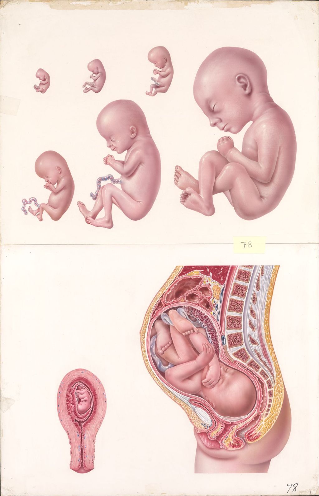 Miniature of Medical Profiles, Finished Art and Mechanical, Diuril and Hydrodiuril, Stages of Pregnancy