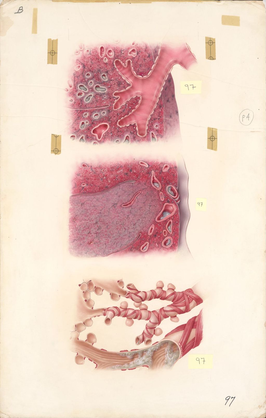 Miniature of Medical Profiles, Dornavac in various respiratory diseases, Plate II
