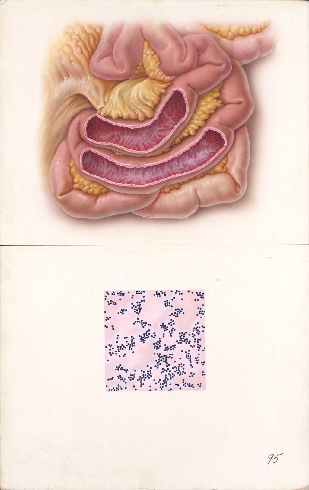 Miniature of Medical Profiles, Ne[illegible]adine Infections of the Intestine, Plate I, Acute Staphylococcal Enteritis
