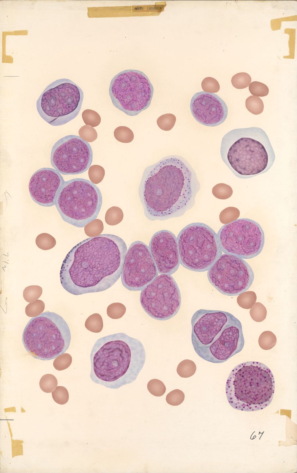 Miniature of Medical Profiles, Blood Dyscrasias, Acute Leukemia