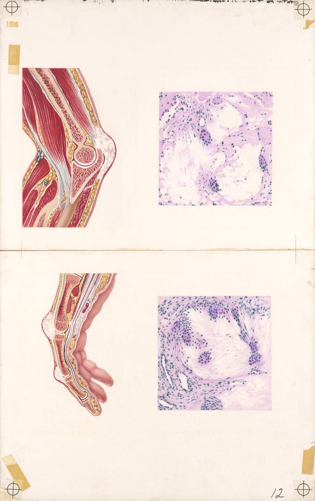 Medical Profiles, Gout, (Benemid), Plate I