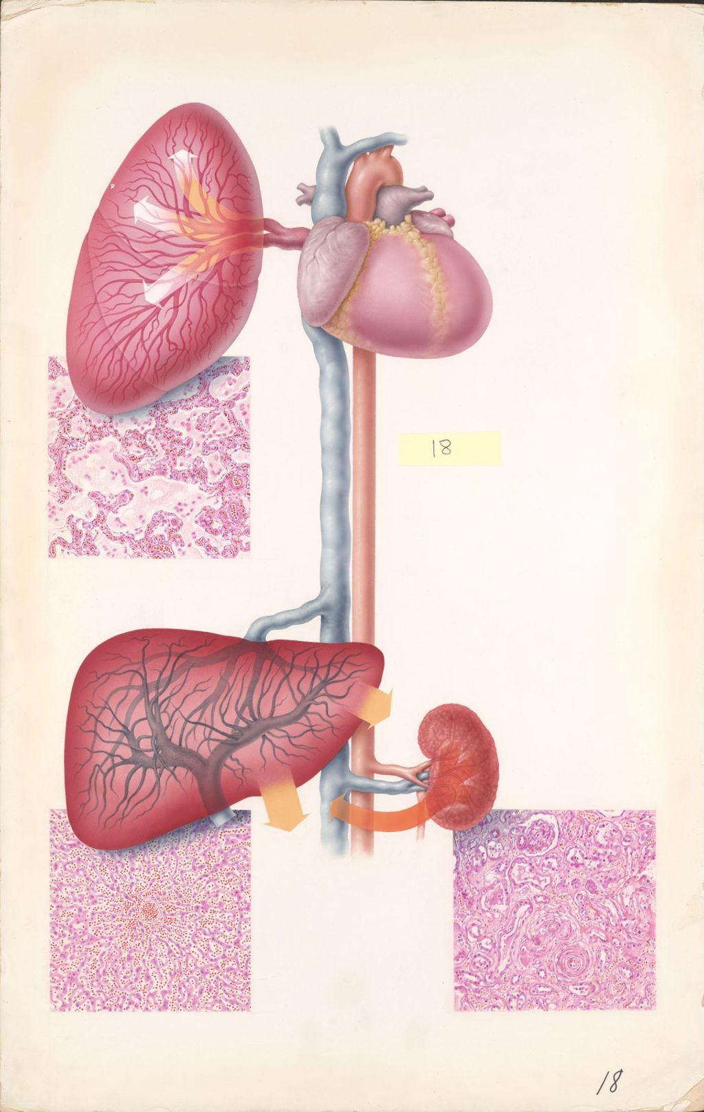 Miniature of Medical Profiles, Diuril-Hydrodiuril, Plate II, Fluid retention in the patient with failing hypertensive heart