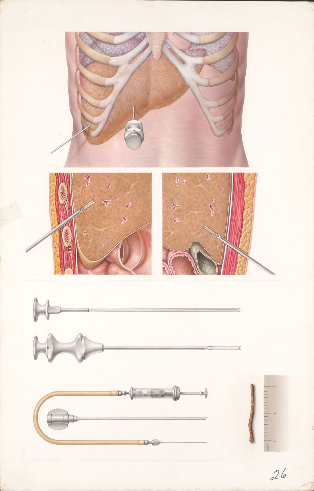 Miniature of Medical Profiles, Diupres-HydroPres, Liver Biopsy, Plate I, Needle Biopsy