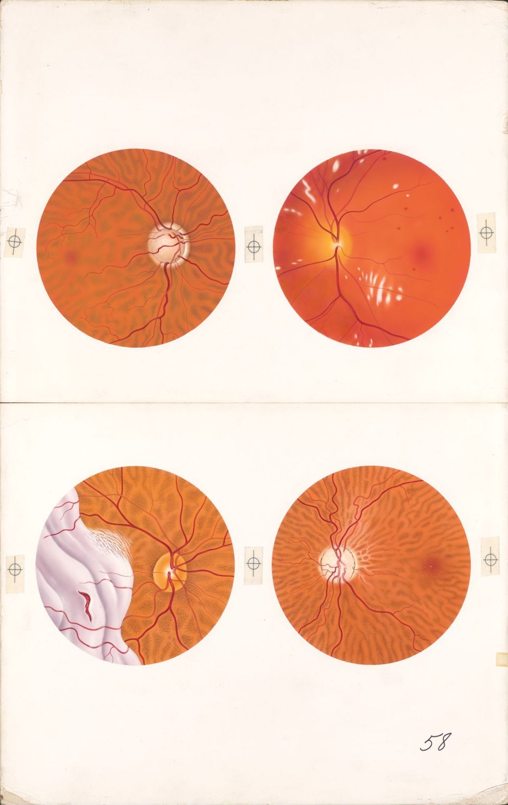 Miniature of Medical Profiles, Ophthalmoscopic Views in Various Diseases, Plate II