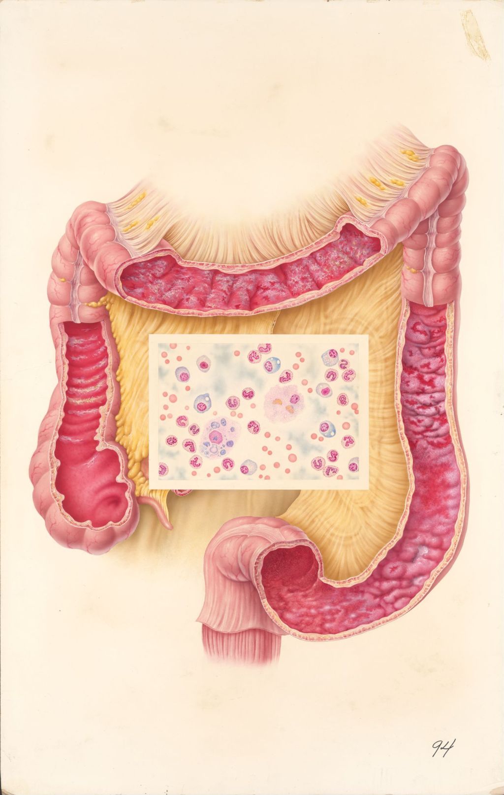 Miniature of Medical Profiles, Neothaladine, Infections of the Intestine, Plate II, Acute Shigellosis (Bacillary Dysentery)