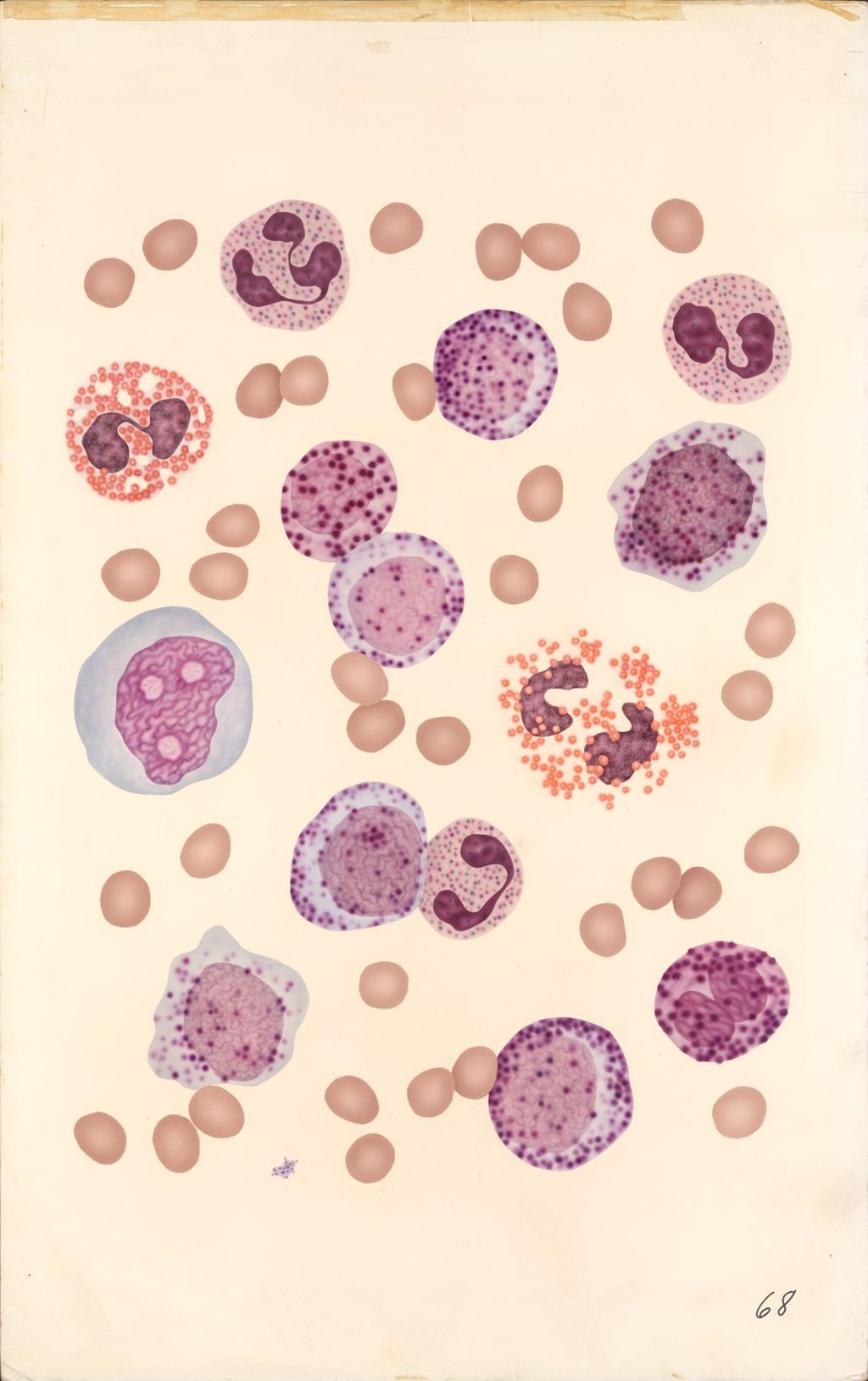Miniature of Medical Profiles, Blood Dyscrasias, Chronic Myeloid Leukemia