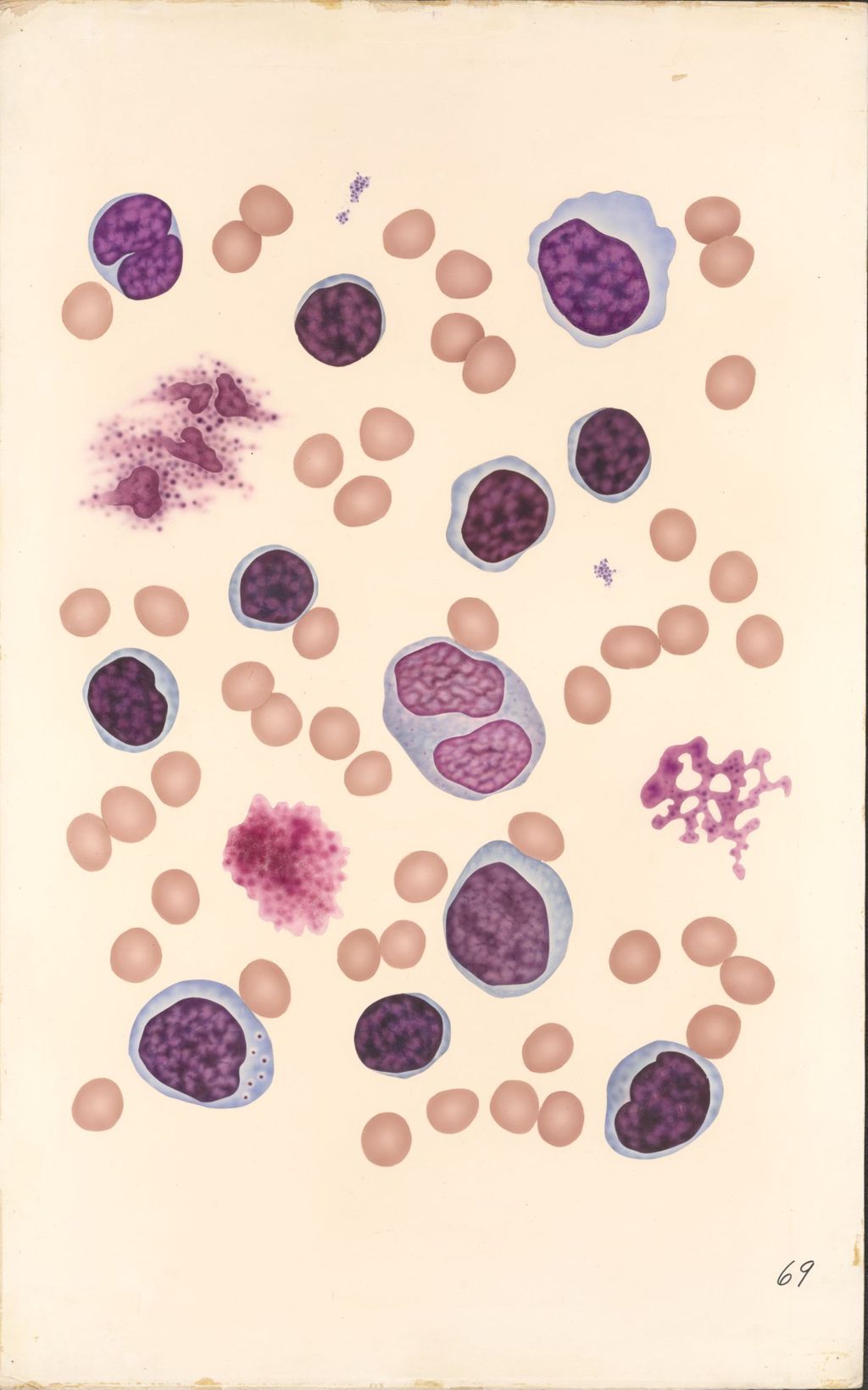 Miniature of Medical Profiles, Blood Dyscrasias, Chronic Lymphoid Leukemia