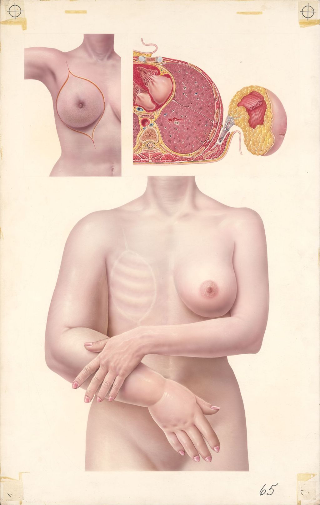Miniature of Medical Profiles, Edema of the Arm Following Radical Mastectomy (Diuril-HD)