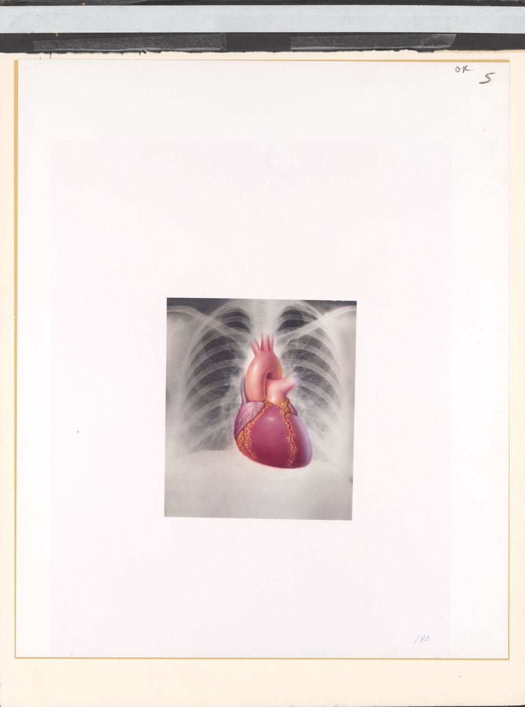 Miniature of Heart with chest x-ray
